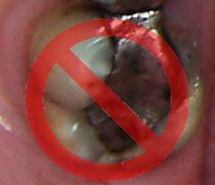 Mercury Free and Mercury Safe Dentist Middletown New Jersey Dr Korwin